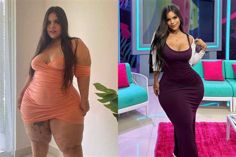 gracie bon surgeries|Woman, Suffering From Condition That Distorts Body Shape,。